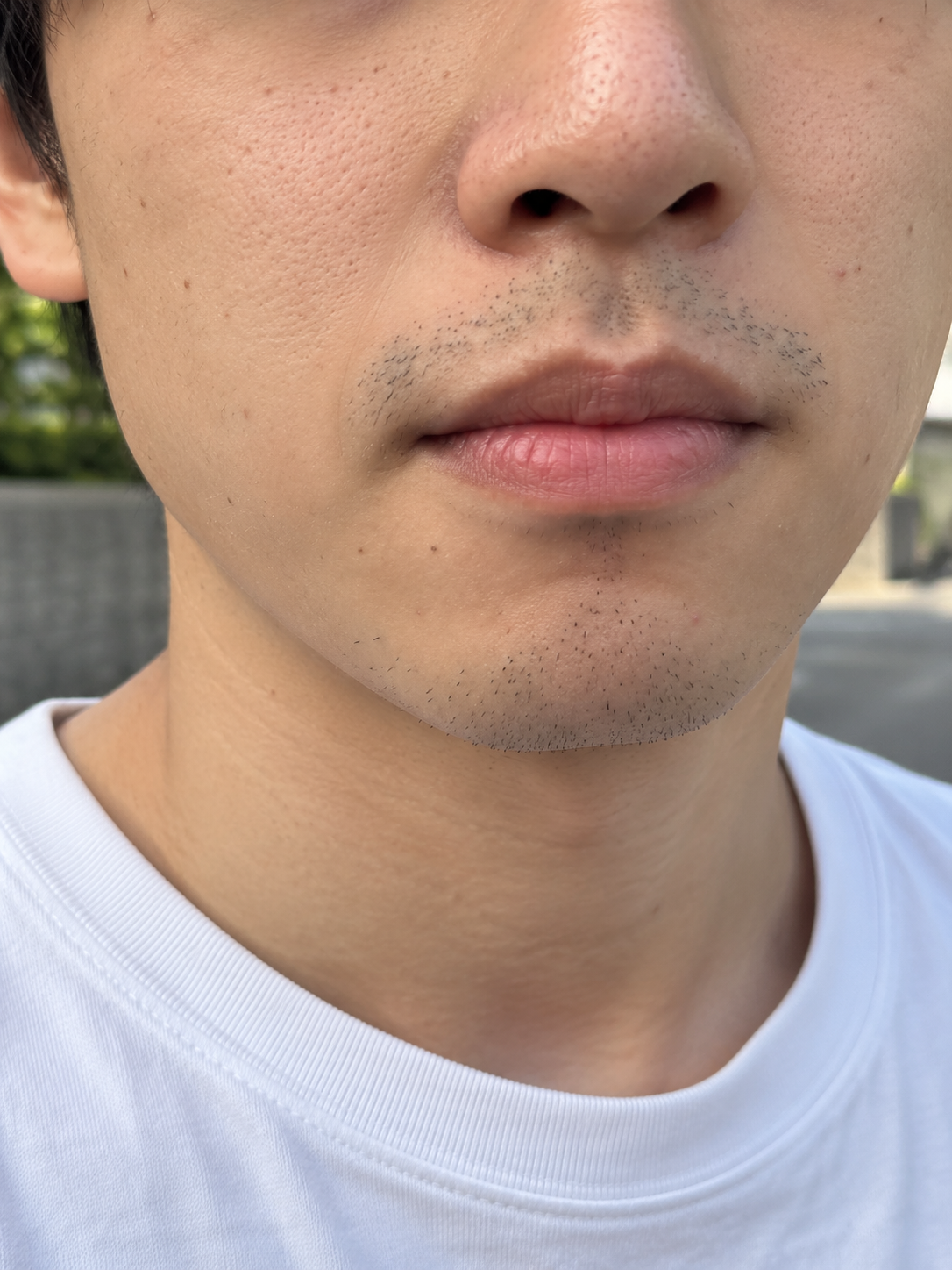 ひげ 施術前（ビフォー）